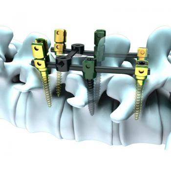 Master9脊柱內(nèi)固定系統(tǒng)