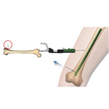 芯鉆髓內釘